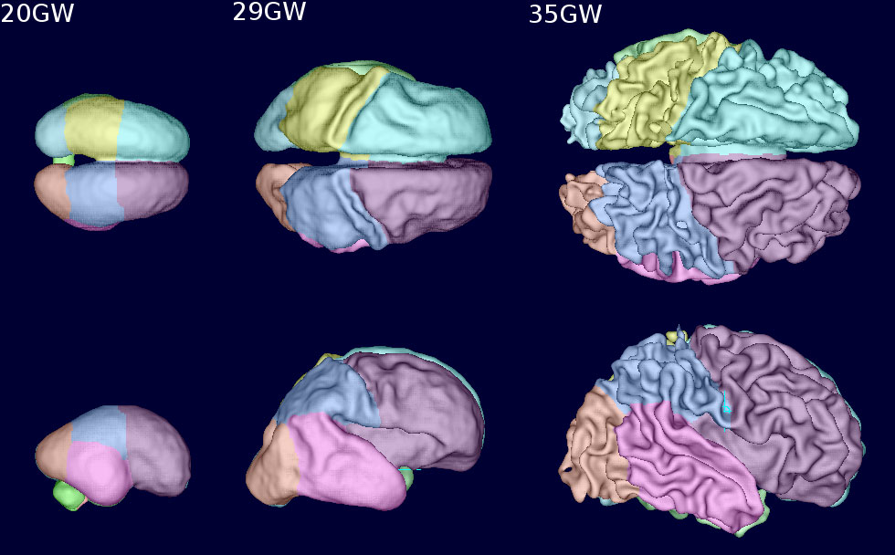 MRI motion correction techniques captured these images of fetal brain surface growth at 20, 29 and 35 weeks gestation. 