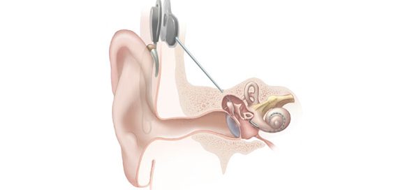 Image of cochlear implant