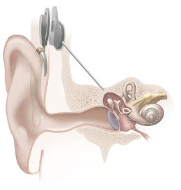 Image of cochlear implant