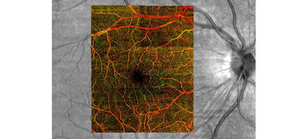 Image of retina vessels