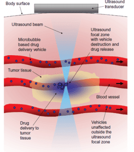 Illustration of ultrasound-based drug delivery to tumor