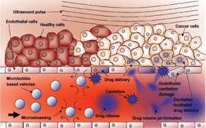 Illustration of ultrasound-mediated drug delivery to cancer cells