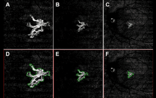 Comparison-of-Neovascular-Lesion-Area-Measurements-From-Different-Swept-Source-OCT-Angiographic-Scan-Patterns-in-Age-Related-Macular-Degeneration