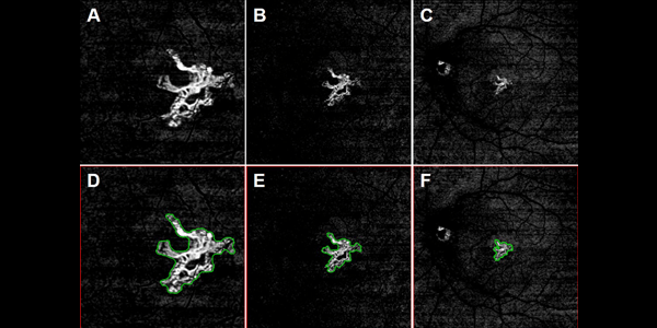 Comparison-of-Neovascular-Lesion-Area-Measurements-From-Different-Swept-Source-OCT-Angiographic-Scan-Patterns-in-Age-Related-Macular-Degeneration