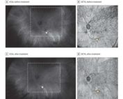 Identification of Choroidal Flow Voids Corresponding to Indocyanine Green Angiography (ICGA) Lesions via Swept-Source Optical Coherence Tomography Angiography (SS-OCTA)