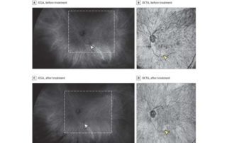 Identification of Choroidal Flow Voids Corresponding to Indocyanine Green Angiography (ICGA) Lesions via Swept-Source Optical Coherence Tomography Angiography (SS-OCTA)
