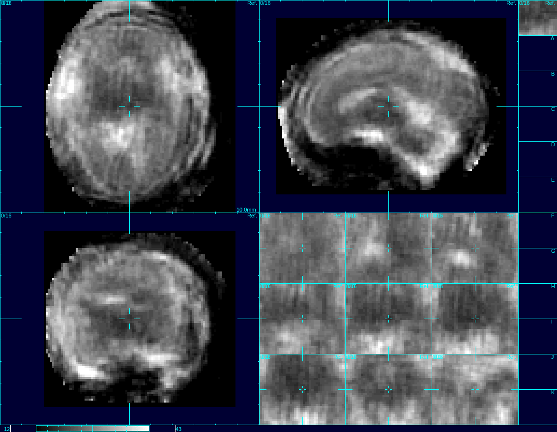 Morion corrected moving images of fetal brain