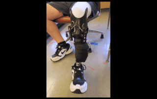 leg with prosthetic socket