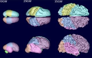 fetal brain growth shown with new MRI method
