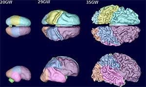 MRI image of an infant brain