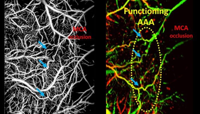 Monitoring arteriogenesis at the cerebral arteriolo-arteriolar anastomoses (AAAs) in mouse brain during middle cerebral artery occlusion using OCT-based microangiography (OMAG) (left) and Doppler OMAG (right).