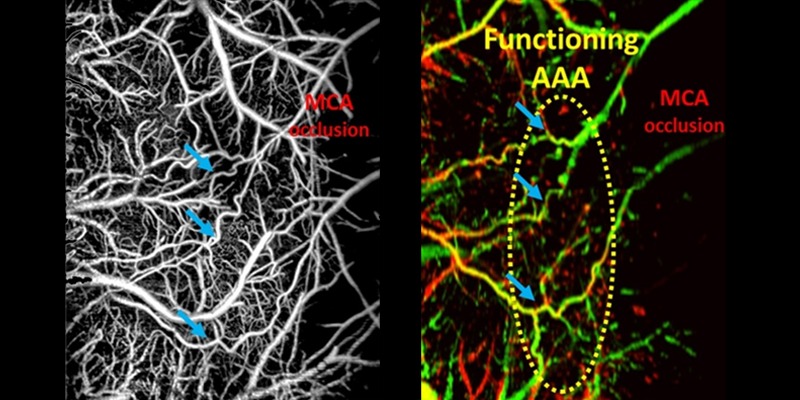 Monitoring arteriogenesis at the cerebral arteriolo-arteriolar anastomoses (AAAs) in mouse brain during middle cerebral artery occlusion using OCT-based microangiography (OMAG) (left) and Doppler OMAG (right).